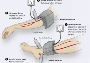 Ankle Brachial Index Worksheet and Development Of An Electromagnetic Induction Method for Non Invasive