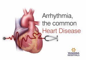 Heart Valves and the Cardiac Cycle Worksheet Answers and Arrhythmia the Mon Heart Disease