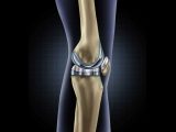 Virtual Hip Replacement Surgery Worksheet Answers or Kniegelenk Prothese Kniegelenkersatz Knstliches Kniegel