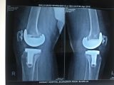 Virtual Hip Replacement Surgery Worksheet Answers with Dr Rajashekar K T Best Joint Hip and Knee Replacement Su