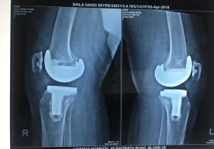 Virtual Hip Replacement Surgery Worksheet Answers with Dr Rajashekar K T Best Joint Hip and Knee Replacement Su
